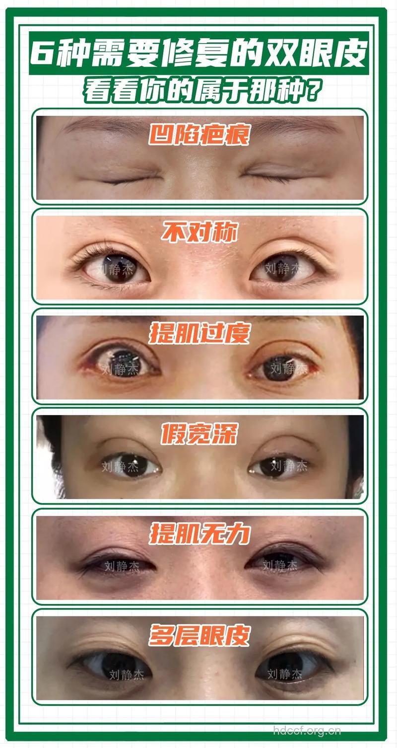 需要做双眼皮修复的六种情况