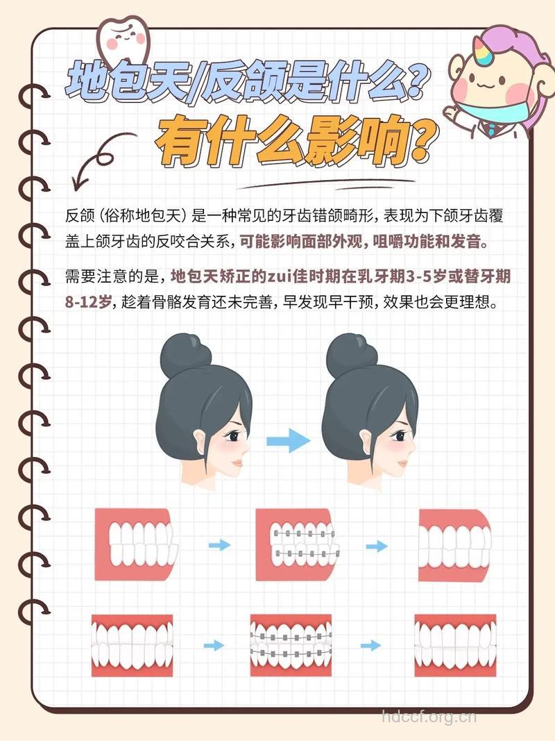 地包天有何危害 怎么矫正地包天呢