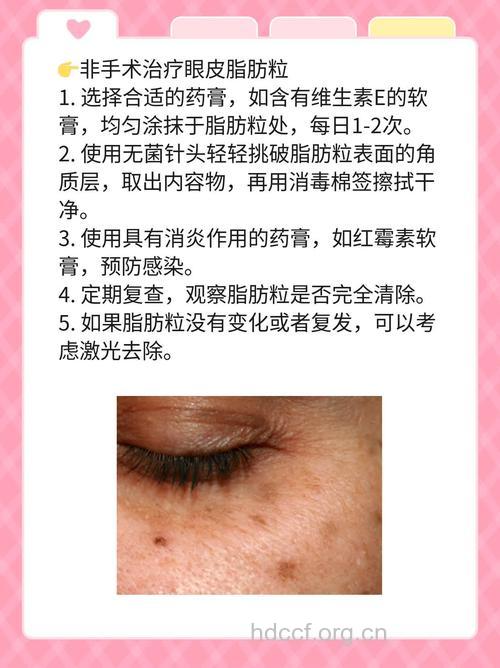 眼部长了脂肪粒怎么办 教你快速去除方法