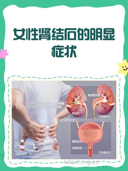 女性肾结石的症状都有什么