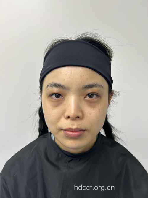 祛眼袋手术安全吗 安全性高不易留疤