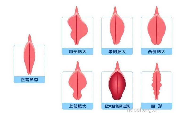 私密整形：阴蒂肥大整形效果怎么样？