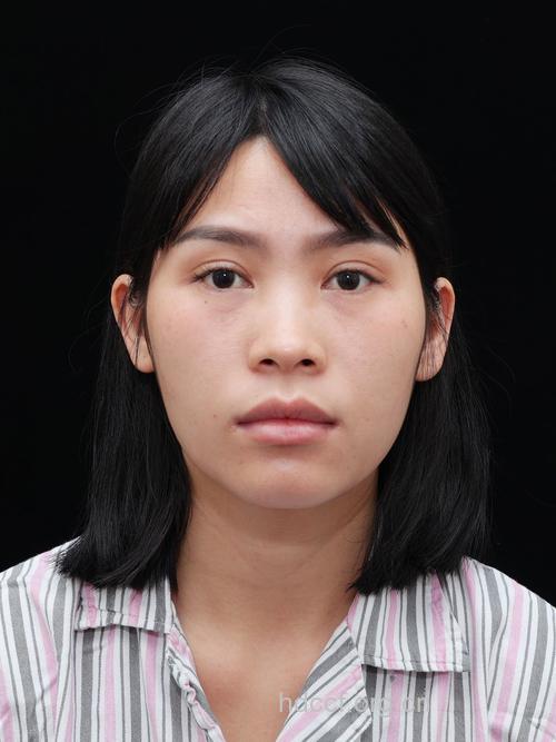 膨体隆鼻手术效果自然吗 材质较软自然无痕