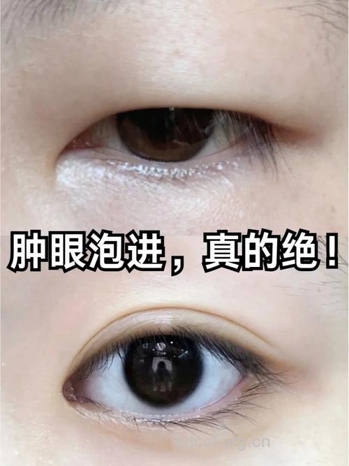 肿眼泡可以割双眼皮吗 让你双眼更漂亮