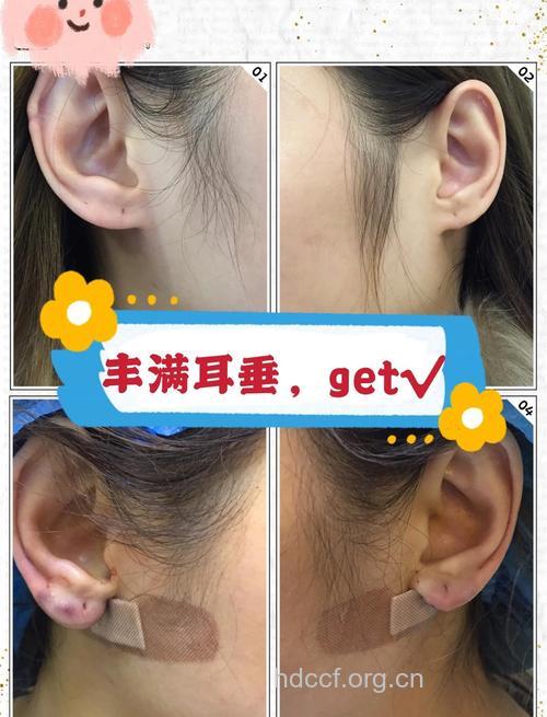 耳垂单薄怎么办 整形让你拥有饱满耳朵