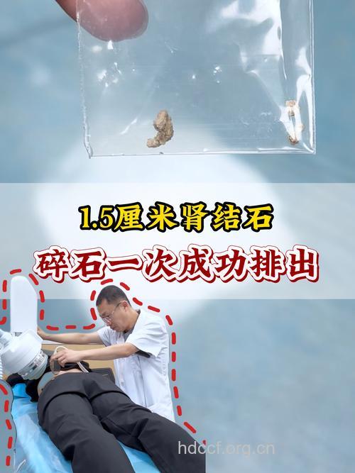 关于肾结石有哪些检查方法