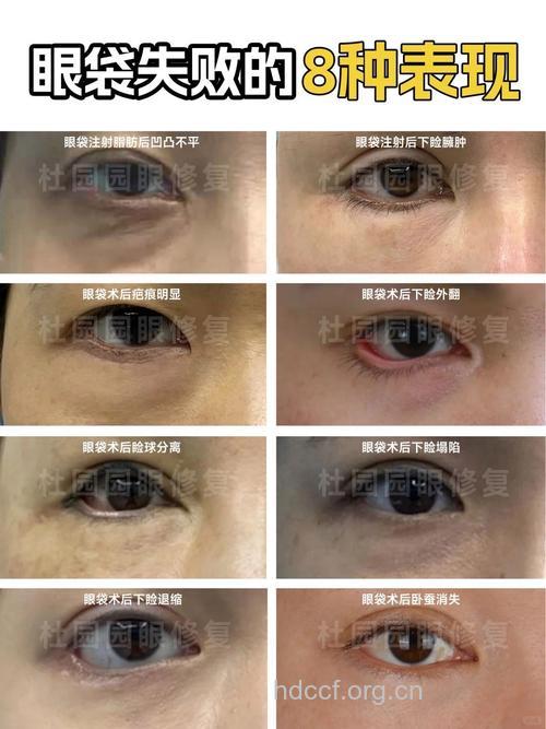 祛眼袋失败后 3类人不适宜做修复