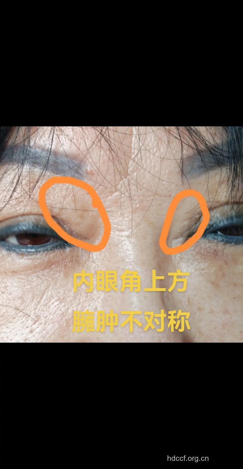 眼皮脂肪太厚能割双眼皮吗