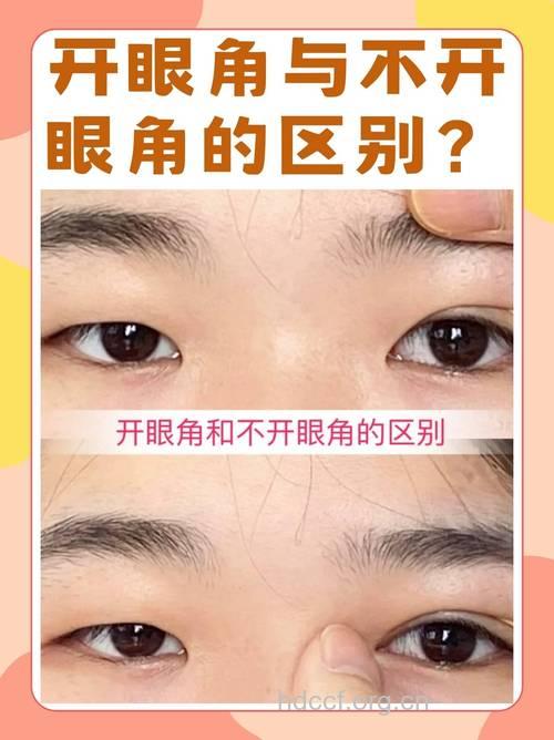 开眼角并没那么简单 三类人不宜开眼角