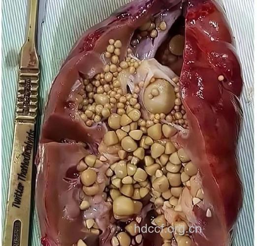 什么是感染性肾结石？