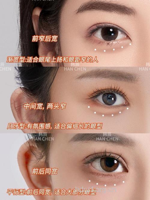 三种卧蚕整形术 让你变得明媚动人