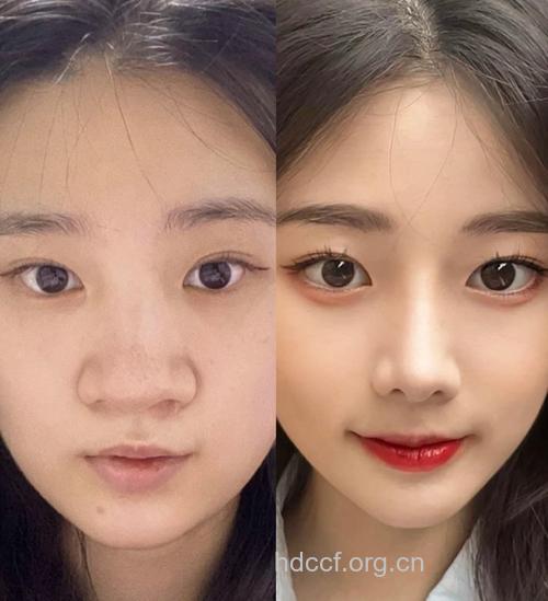 拯救难看塌鼻子 试试这三种手术