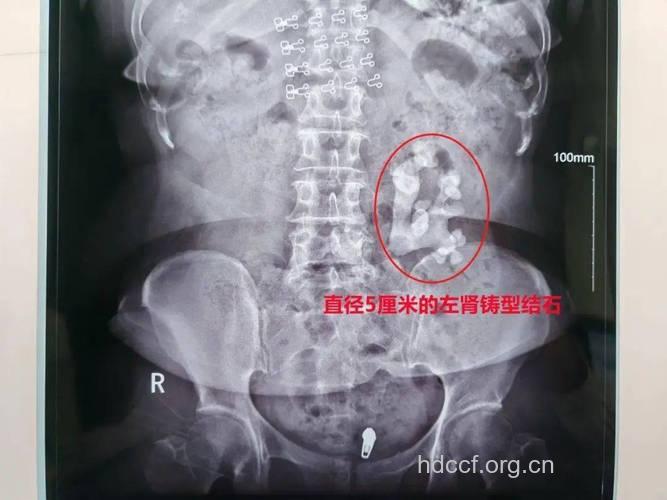 X光可查出大部分肾结石