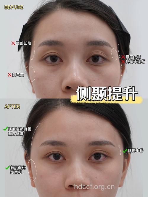 太阳穴凹陷？两招帮你完美填充