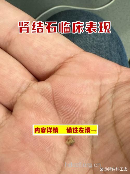 感染性肾结石的血尿症状