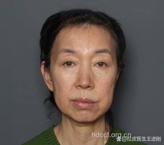 磨颧骨过度危害大 易致面部肌肉扭曲