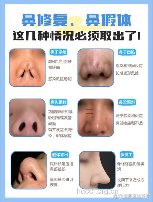 下面这几种情况千万别隆鼻整形