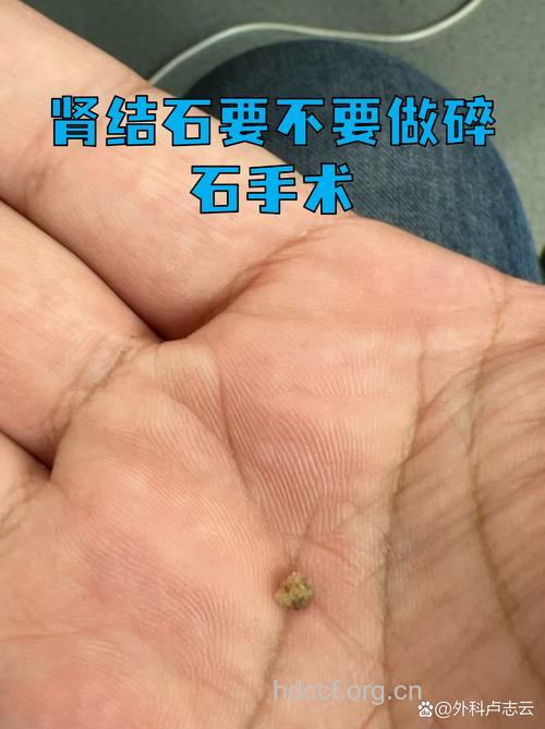 肾结石手术要摘肾情况有哪些