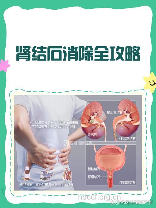 肾结石的不同治疗方法