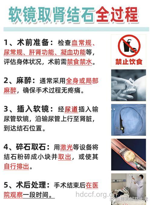 治疗肾结石需要多少钱