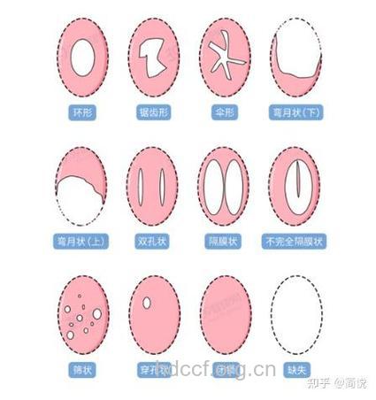 处女膜修复手术后 婚检会发现吗