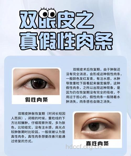 割双眼皮的肉条是怎么形成的