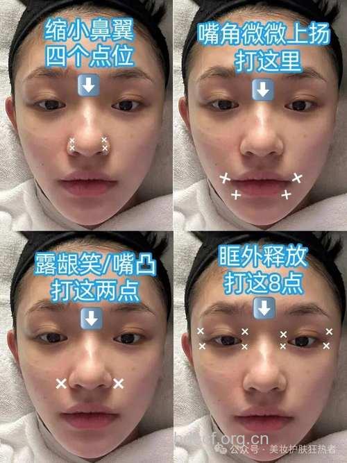 肉毒素可以缩小鼻头吗？别轻易被忽悠了