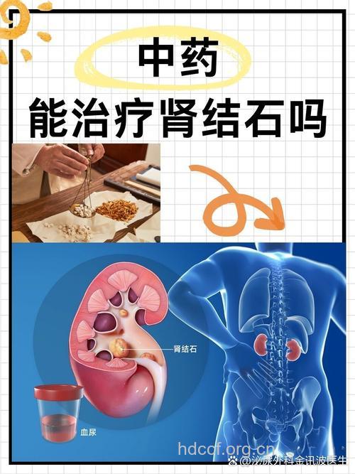 中医治疗肾结石有效果吗