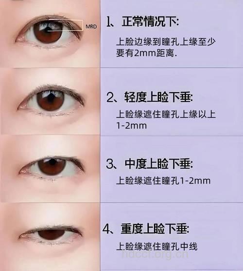 眼角下垂能开眼角吗 4类人适宜开眼角