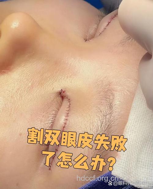 欧式双眼皮失败后 能不能修复