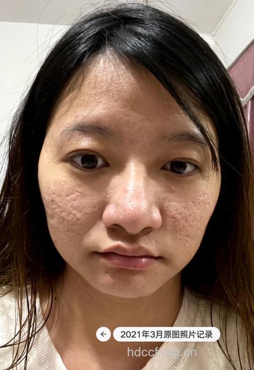 满脸是痘还能打玻尿酸吗?