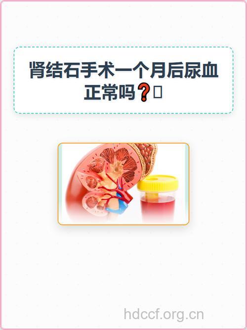 肾结石经皮肾镜取石术后出血怎么办