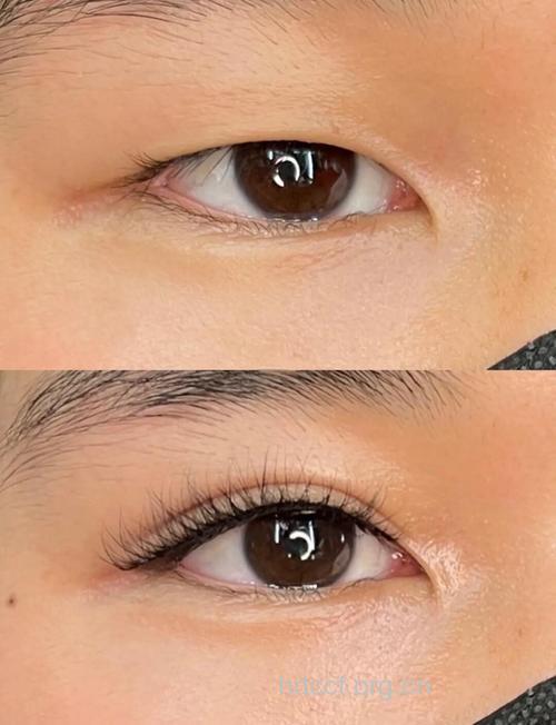 五类人不宜做三角眼矫正术