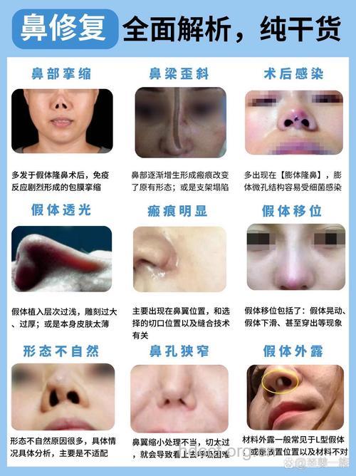 几类人需要做隆鼻手术