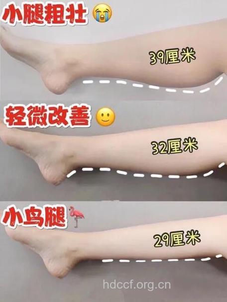 botox瘦腿效果好吗 botox瘦小腿的五大疑问