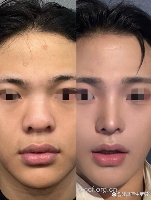 自体脂肪隆鼻 男性适合哪些隆鼻方法