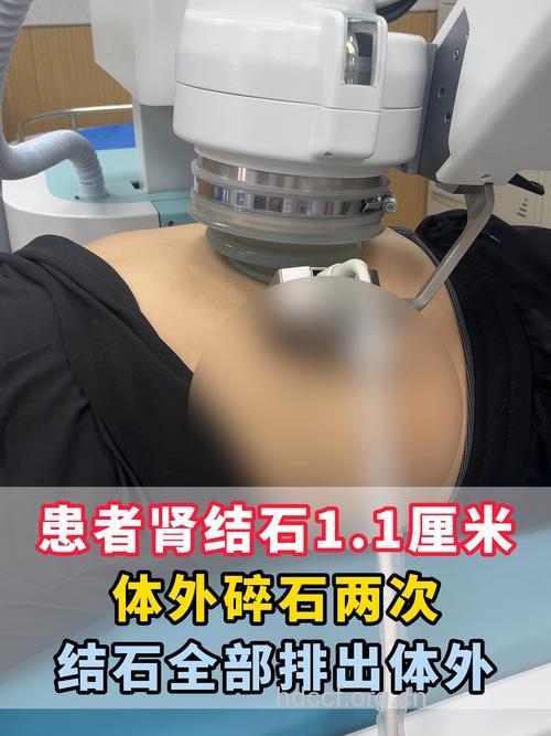 体外碎石真的安全吗