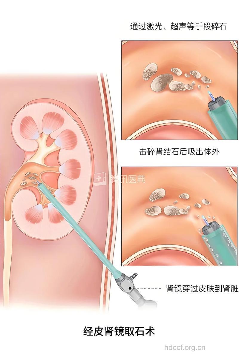 如何进行肾结石碎石疗法
