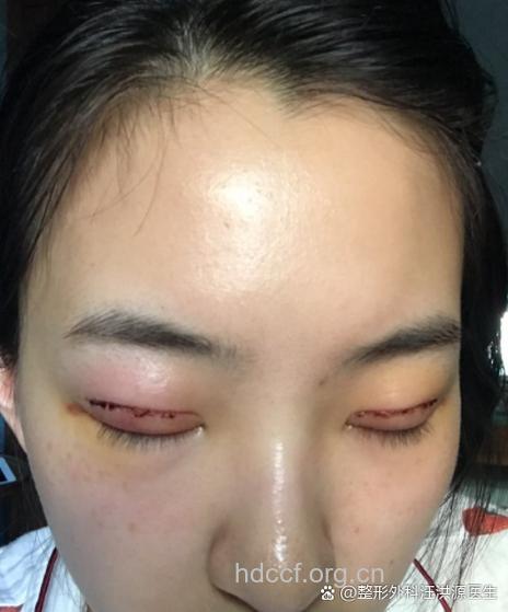 女子割双眼皮死手术台上 割双眼皮有哪些危害