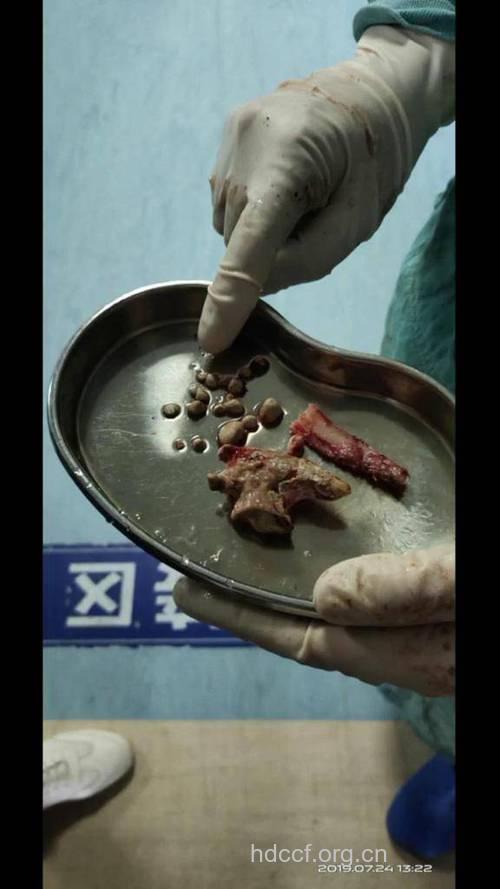 不开刀取出肾结石