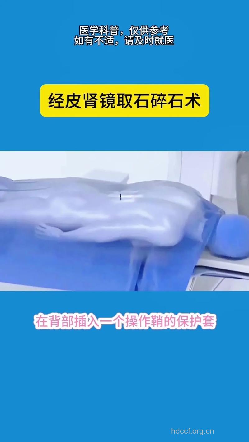 是否要到医院做碎石治疗？