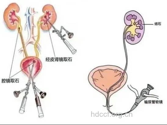 钬激光对付肾结石的几大优点