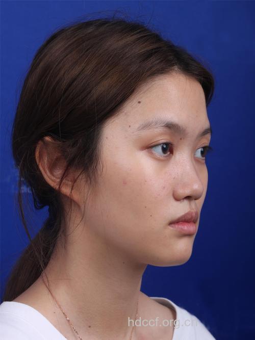 做自信女人就选韩式隆鼻