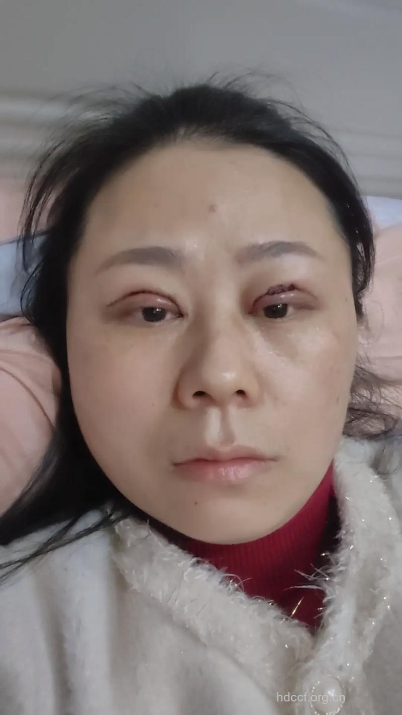 割双眼皮会有后遗症吗