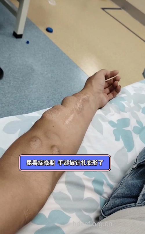 尿毒症晚期3大症状表现
