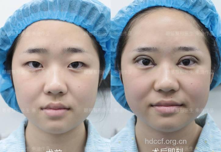开眼角术适用人群 打造真人芭比娃娃