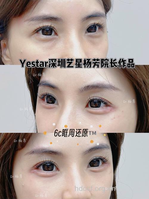 人工真皮再造卧蚕 打造魅惑电眼