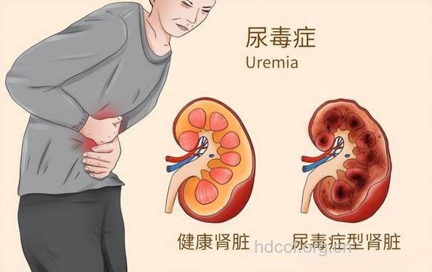 惊：剧烈运动容易导致肾衰竭