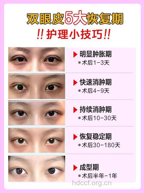 双眼皮术后5大护理 加速变电眼