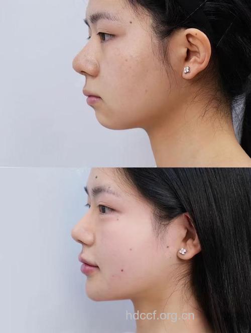 假体隆下巴怎样更好看